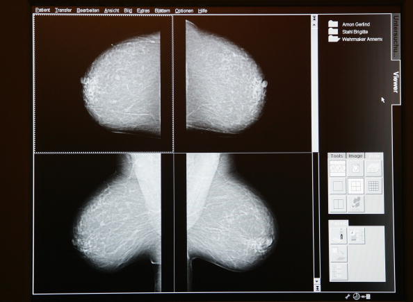 The number of cases of breast cancer in women will rise by 50% by 2030. The number of cases of breast cancer in women will rise by 50% by 2030.