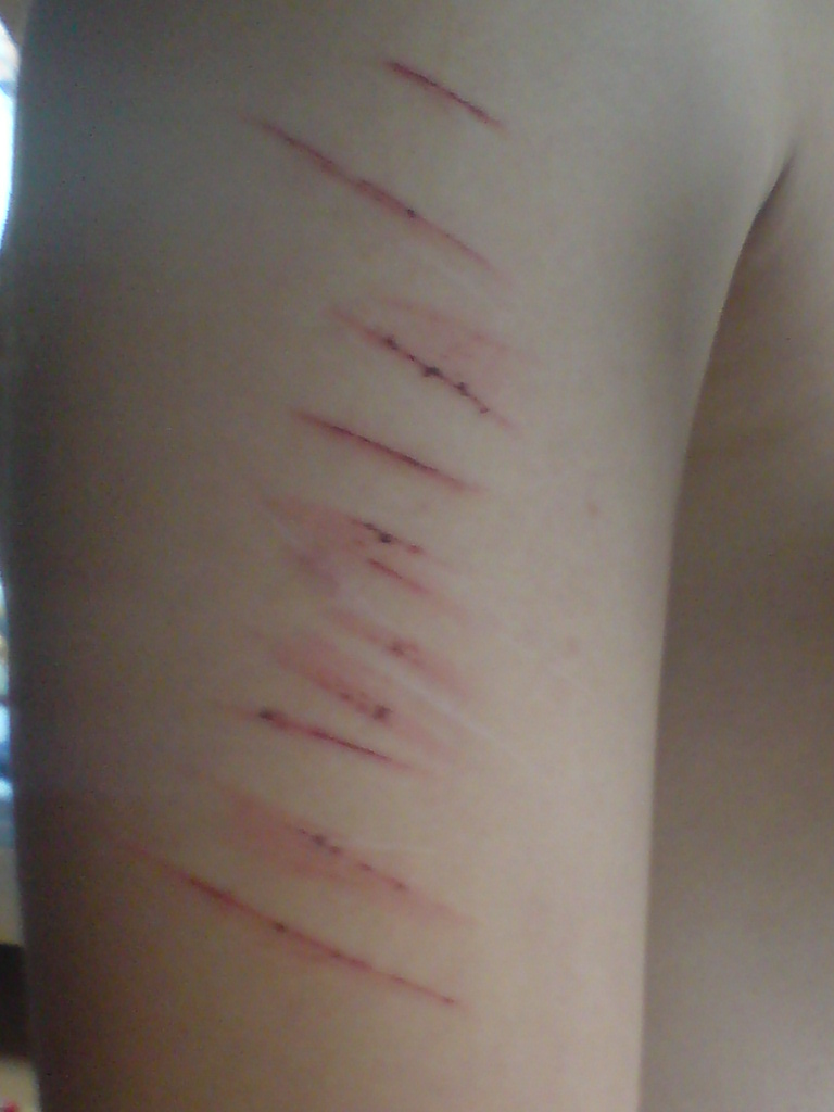 Self-inflicted cuts on a teen's arm. The number of teens treated in th emergency room due to self-inflicted injuries is rising. Self-inflicted cuts on a teen's arm. The number of teens treated in th emergency room due to self-inflicted injuries is rising.