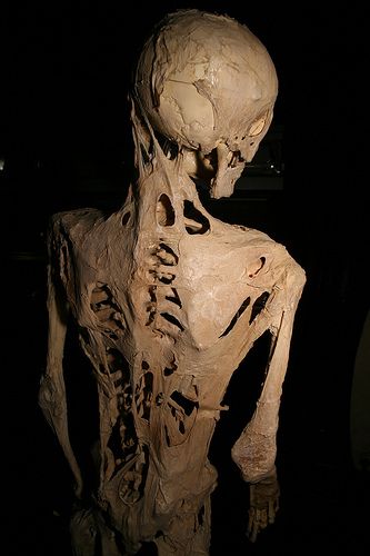 The skeleton of a person who suffered from fibrodysplasia ossificans progressiva, a rare condition that causes soft tissue to turn to bone. The skeleton of a person who suffered from fibrodysplasia ossificans progressiva, a rare condition that causes soft tissue to turn to bone.