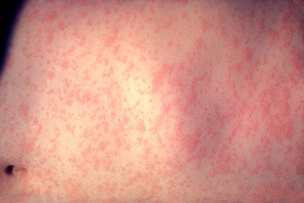 Skin rashes