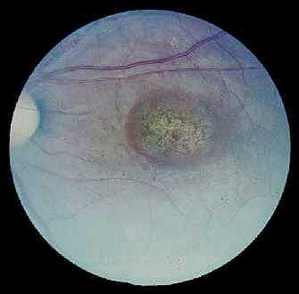 An image of the retina of a person with macular degeneration. An image of the retina of a person with macular degeneration.