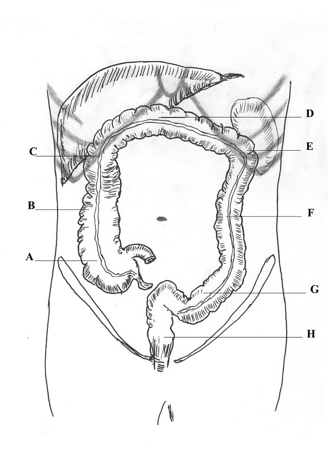 Vitamin D deficiency has been associated with irritable bowel syndrome. Vitamin D deficiency has been associated with irritable bowel syndrome.