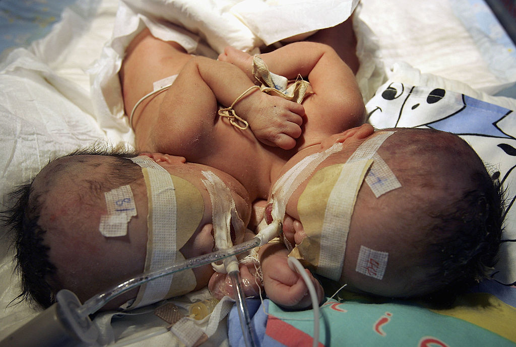 Swiss Doctors Succeed In Surgical Separation Of Youngest Ever Conjoined Twins Swiss Doctors Succeed In Surgical Separation Of Youngest Ever Conjoined Twins