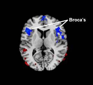 Broca's Area, Located in the Frontal Lobe of Brain Broca's Area, Located in the Frontal Lobe of Brain