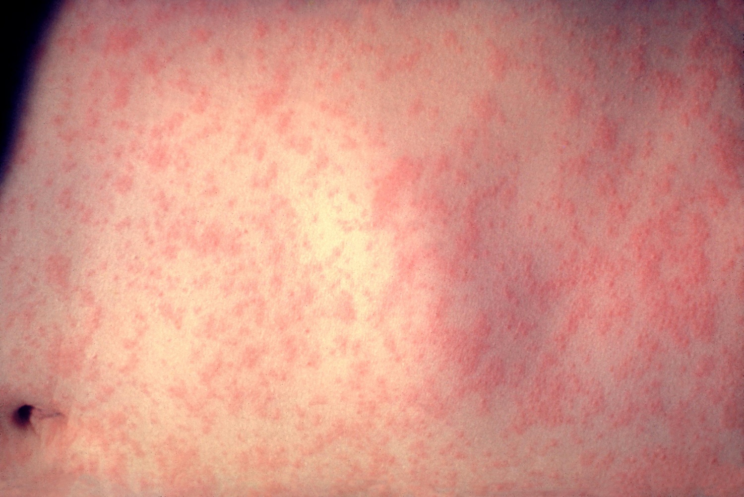 Measles vaccination gaps in teenagers and young adults highlighted in ECDC's report Measles vaccination gaps in teenagers and young adults highlighted in ECDC's report