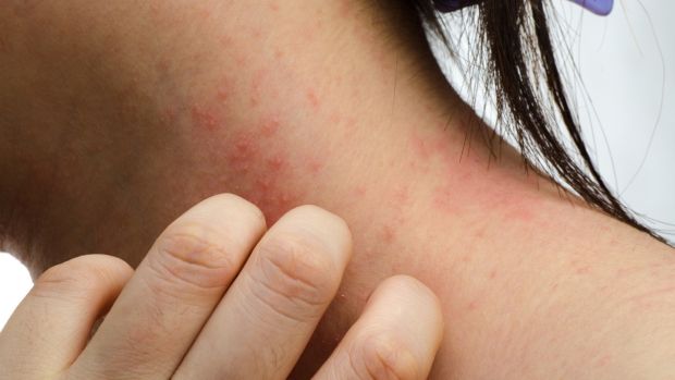 Kids Eczema Kids Eczema
