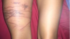 Unique Report Details Dermatological Progression and Effective Treatment of a Severe Jellyfish Sting (IMAGE) Unique Report Details Dermatological Progression and Effective Treatment of a Severe Jellyfish Sting (IMAGE)