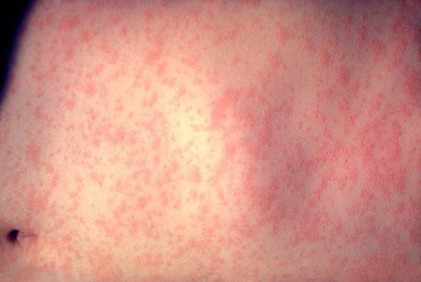 Measles is not just a rash. It can effect your eyesight even before the red spots appear. 