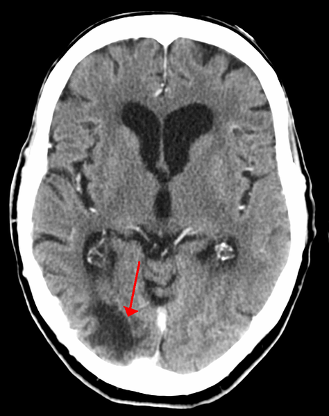 A CAT scan showing the effects of a stroke. The darkened area below the pointer is the area where the stroke occurred. 