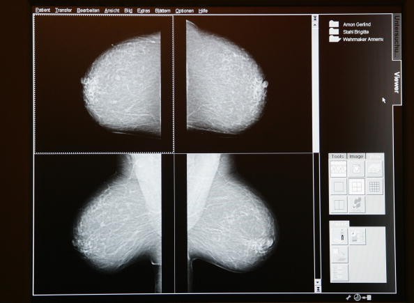 Some guidelines call for women to start having mammograms at age 50, but many still start before then. 
