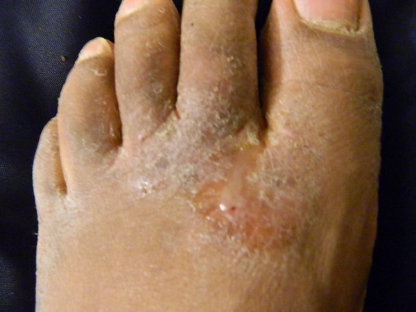 Athlete's foot is a painful and itchy condition on your feet