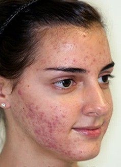 Acne can be an embarrassing circumstance for teens