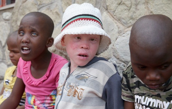 A children with albinism in Lesotho. In parts of Africa people with albinism are hunted and killed or mutilated.