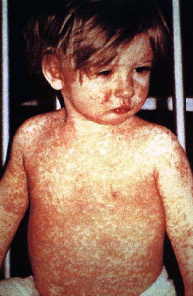 A child with a typical measles rash. An American woman died of measles this spring, the first death due to the virus in the United States in 12 years. 