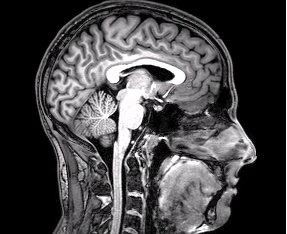 An MRI of the brain. 