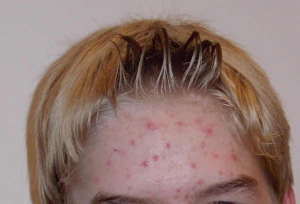 Boy with acne on his forehead.