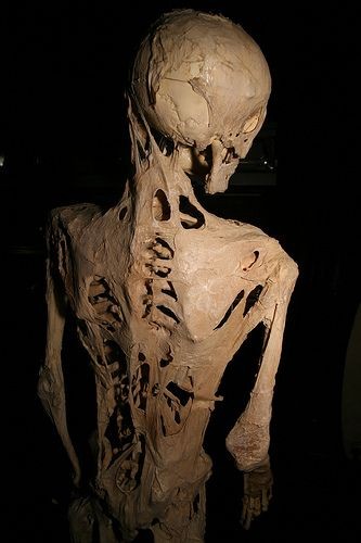 The skeleton of a person who suffered from fibrodysplasia ossificans progressiva, a rare condition that causes soft tissue to turn to bone.