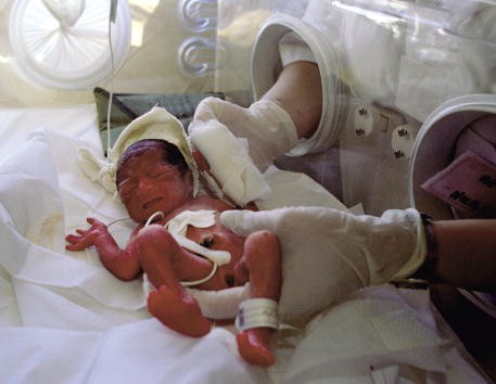 Premature babies are at a high risk of developing mental disorder