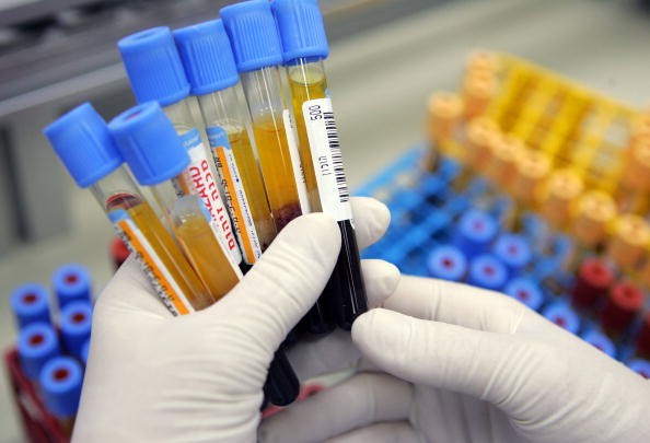 A newly developed blood test can detect Alzheimer's disease at the early stage.