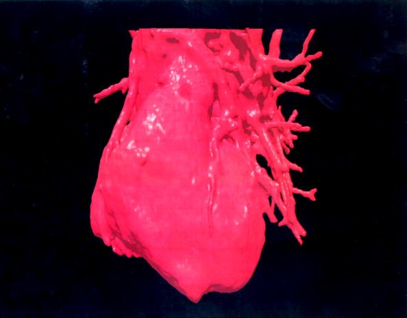 A Three-Dimensional (3-D) Image of a Human Heart