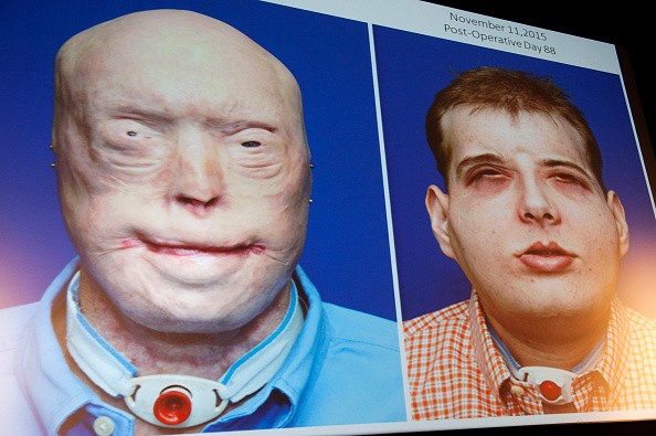 Patrick Hardison, 41, before and after he received a transplant of a face and scalp.