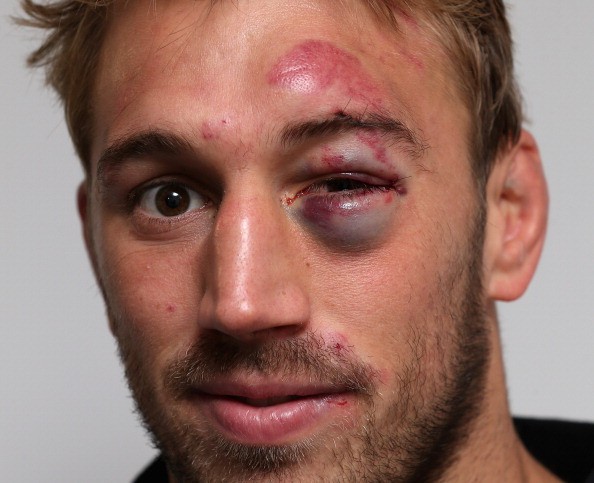 The most common causes of serious eye injuries are falls or fights, but in this photo, Chris Robshaw shows off an injury incurred during a rugby game. 