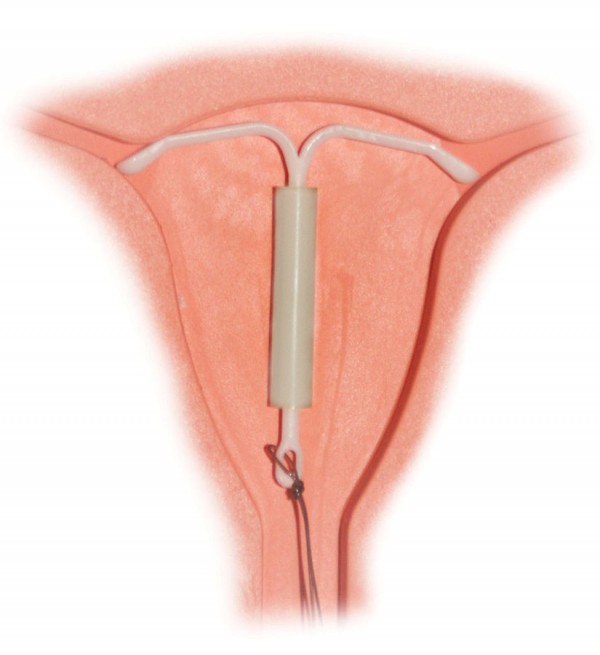 A diagram of an IUD in place in the uterus. 