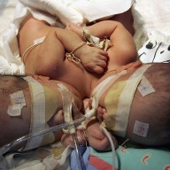 Swiss Doctors Succeed In Surgical Separation Of Youngest Ever Conjoined Twins