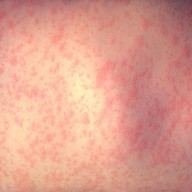 Measles vaccination gaps in teenagers and young adults highlighted in ECDC's report