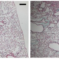 A Mutation In SFTPA1 Causes Idiopathic Pulmonary Fibrosis (IMAGE)