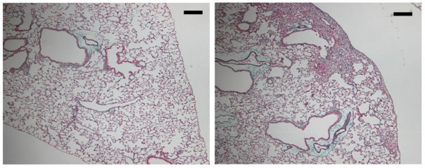 A Mutation In SFTPA1 Causes Idiopathic Pulmonary Fibrosis (IMAGE)