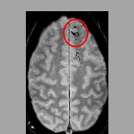 Traumatic Microbleeds in the Brain (IMAGE)
