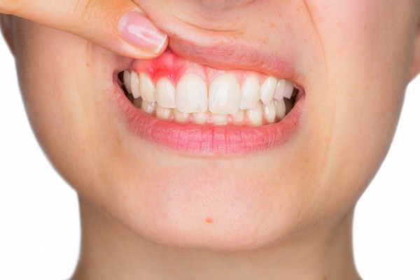 A Guide on How to Stop Bleeding Gums
