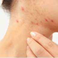 Hormonal Acne: How to Know If Your Acne is Hormonal