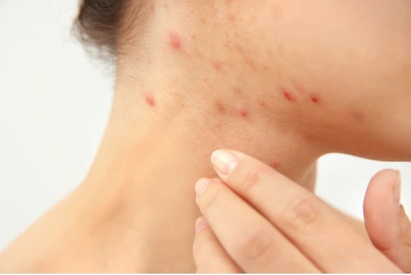 Hormonal Acne: How to Know If Your Acne is Hormonal
