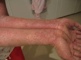 The incidence of eczema, an allergic skin condition, is increasing. 