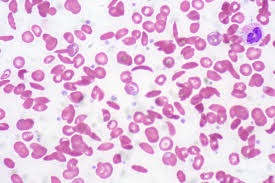 In sickle-cell anemia, some blood cells can turn from the normal round shape into rigid sickle-shaped cells. 
