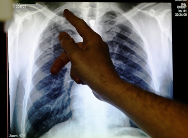 Warm Weather Increase Risk Factors for Chronic Lung Infections