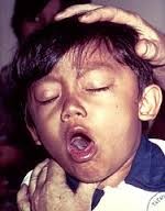 A child with whooping cough. The disease causes violent coughing fits that are hard to control. 