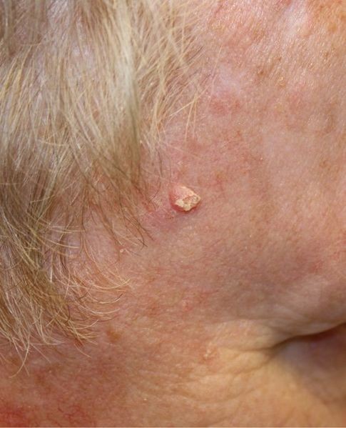 Squamous cell carcinoma, a type of skin cancer 