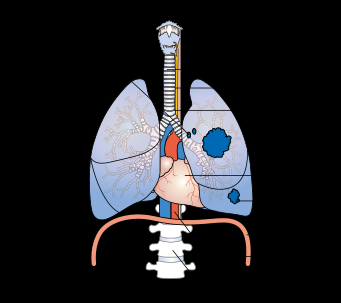 Diagram showing stage 3A lung cancer.
