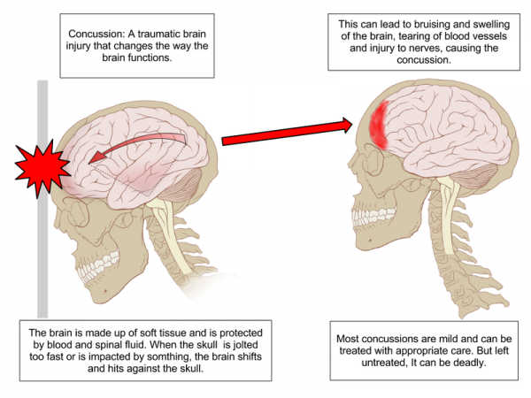 What happens to your brain during a concussion. 