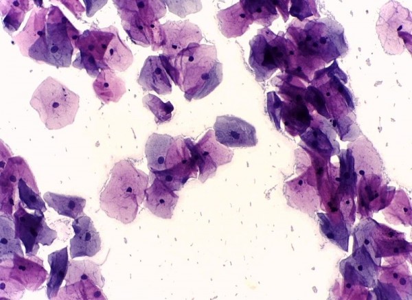 A microscopic view of normal cervical cells, taken with a Pap test. 