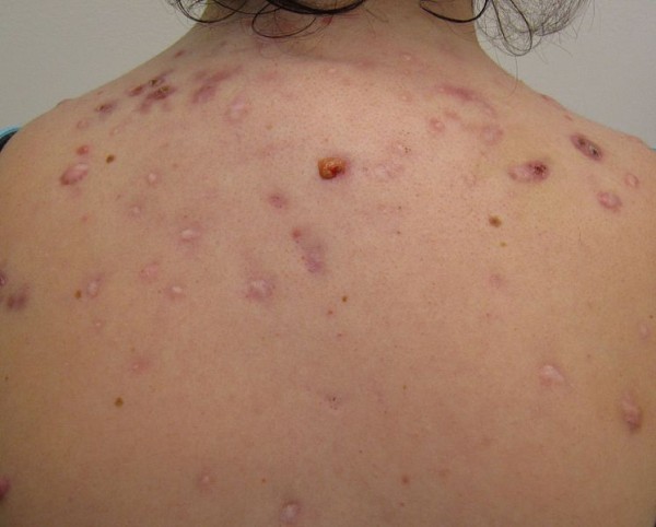Cystic acne on the back.